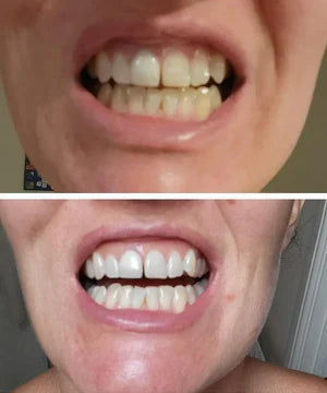 Eloura Purple Teeth Whitening Strips